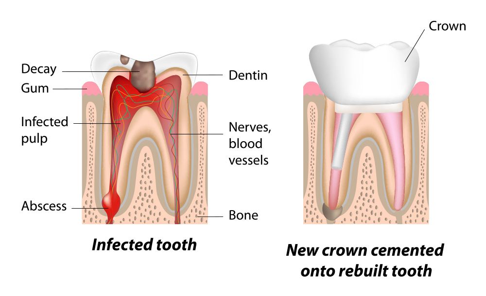illustration of root canal treatment