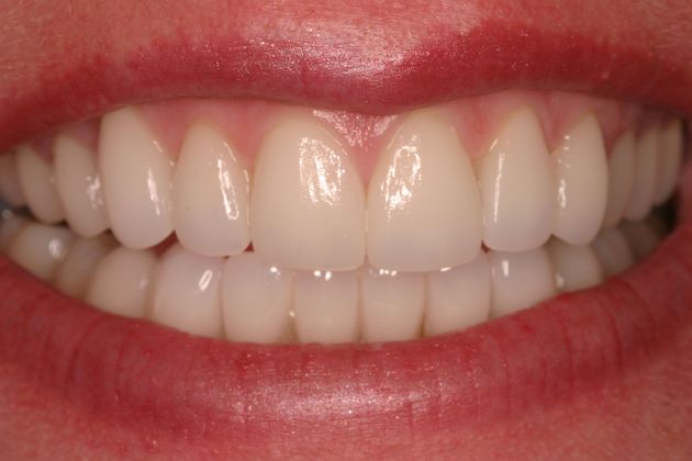 after veneers